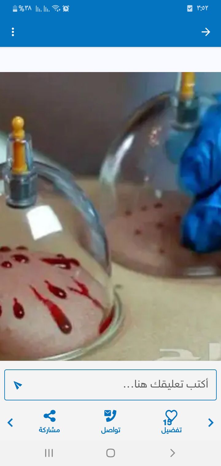 حجامة نبويه مكة